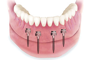 Implant-Supported Dentures with MDIs